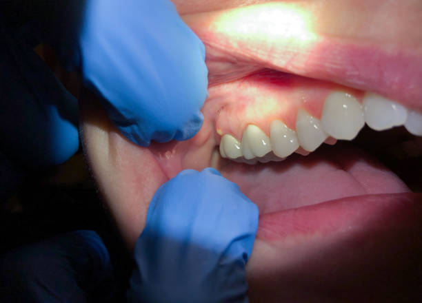 Best Urgent Tooth Repair  in Seacliff, CA